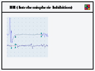 IH (Interhemispheric Inhibition)
I

 