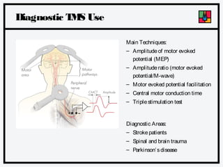Diagnostic T S Use
M
Main Techniques:
– Amplitude of motor evoked
potential (MEP)
– Amplitude ratio (motor evoked
potential/M-wave)
– Motor evoked potential facilitation
– Central motor conduction time
– Triple stimulation test

Diagnostic Areas:
– Stroke patients
– Spinal and brain trauma
– Parkinson’ s disease

 