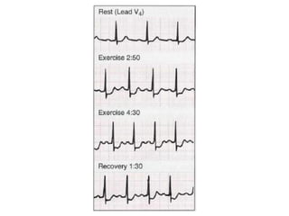 TMT is a test for heart regulation system | PDF