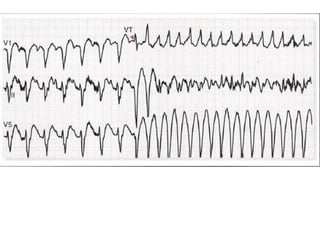 TMT is a test for heart regulation system | PDF