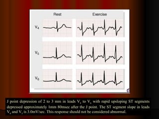J point depression of 2 to 3 mm in leads V 4  to V 6  with rapid upsloping ST segments depressed approximately 1mm 80msec after the J point. The ST segment slope in leads V 4  and V 5  is 3.0mV/sec. This response should not be considered abnormal. 