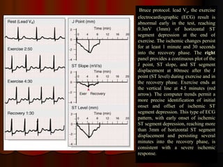   Bruce protocol. lead V 4 , the exercise electrocardiographic (ECG) result is abnormal early in the test, reaching 0.3mV (3mm) of horizontal ST segment depression at the end of exercise. The ischemic changes persist for at least 1 minute and 30 seconds into the recovery phase. The  right  panel provides a continuous plot of the J point, ST slope, and ST segment displacement at 80msec after the J point (ST level) during exercise and in the recovery phase. Exercise ends at the vertical line at 4.5 minutes (red arrow). The computer trends permit a more precise identification of initial onset and offset of ischemic ST segment depression. This type of ECG pattern, with early onset of ischemic ST segment depression, reaching more than 3mm of horizontal ST segment displacement and persisting several minutes into the recovery phase, is consistent with a severe ischemic response. 