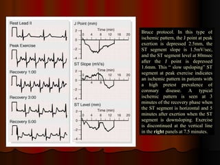 Bruce protocol. In this type of ischemic pattern, the J point at peak exertion is depressed 2.5mm, the ST segment slope is 1.5mV/sec, and the ST segment level at 80msec after the J point is depressed 1.6mm. This “ slow upsloping” ST segment at peak exercise indicates an ischemic pattern in patients with a high pretest prevalence of coronary disease. A typical ischemic pattern is seen at 3 minutes of the recovery phase when the ST segment is horizontal and 5 minutes after exertion when the ST segment is downsloping. Exercise is discontinued at the vertical line in the  right  panels at 7.5 minutes. 