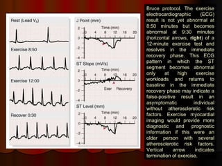 Bruce protocol. The exercise electrocardiographic (ECG) result is not yet abnormal at 8:50 minutes but becomes abnormal at 9:30 minutes (horizontal arrows,  right ) of a 12-minute exercise test and resolves in the immediate recovery phase. This ECG pattern in which the ST segment becomes abnormal only at high exercise workloads and returns to baseline in the immediate recovery phase may indicate a false-positive result in an asymptomatic individual without atherosclerotic risk factors. Exercise myocardial imaging would provide more diagnostic and prognostic information if this were an older person with several atherosclerotic risk factors. Vertical arrow indicates termination of exercise. 