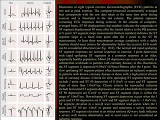 Illustration of eight typical exercise electrocardiographic (ECG) patterns at rest and at peak exertion. The computer-processed incrementally averaged beat corresponds with the raw data taken at the same time point during exercise and is illustrated in the last column. The patterns represent worsening ECG responses during exercise. In the column of computer-averaged beats, ST 80 displacement (top number) indicates the magnitude of ST segment displacement 80 msec after the J point relative to the PQ junction or E point. ST segment slope measurement (bottom number) indicates the ST segment slope at a fixed time point after the J point to the ST 80 measurement. At least three noncomputer average complexes with a stable baseline should meet criteria for abnormality before the exercise ECG result can be considered abnormal (see Fig. 10-9). The normal and rapid upsloping ST segment responses are normal responses to exercise. J point depression with rapid upsloping ST segments is a common response in an older, apparently healthy population. Minor ST depression can occur occasionally at submaximal workloads in patients with coronary disease; in this illustration, the ST segment is depressed 0.09mV (0.9mm) 80msec after the J point. The slow upsloping ST segment pattern often demonstrates an ischemic response in patients with known coronary disease or those with a high pretest clinical risk of coronary disease. Criteria for slow upsloping ST segment depression include J point and ST 80 depression of 0.15mV or more and ST segment slope of more than 1.0mV/sec. Classic criteria for myocardial ischemia include horizontal ST segment depression observed when both the J point and ST 80 depression are 0.1mV or more and ST segment slope is within the range of 1.0mV/sec. Downsloping ST segment depression occurs when the J point and ST 80 depression are 0.1mV and ST segment slope is − 1.0mV/sec. ST segment elevation in a non-Q wave noninfarct lead occurs when the J point and ST 60 are 1.0mV or greater and represents a severe ischemic response. ST segment elevation in an infarct territory (Q wave lead) indicates a severe wall motion abnormality and in most cases is not considered an ischemic response.  