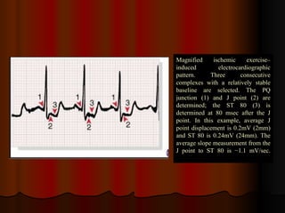 Magnified ischemic exercise– induced electrocardiographic pattern. Three consecutive complexes with a relatively stable baseline are selected. The PQ junction (1) and J point (2) are determined; the ST 80 (3) is determined at 80 msec after the J point. In this example, average J point displacement is 0.2mV (2mm) and ST 80 is 0.24mV (24mm). The average slope measurement from the J point to ST 80 is −1.1 mV/sec. 