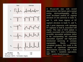 A 48-year-old man with several atherosclerotic risk factors and a normal resting electrocardiographic (ECG) result developed marked ST segment elevation (4 mm [arrows]) in leads V 2  and V 3  with lesser degrees of ST segment elevation in leads V 1  and V 4  and J point depression with upsloping ST segments in lead II, associated with angina. This type of ECG pattern is usually associated with a full-thickness, reversible myocardial perfusion defect in the corresponding left ventricular myocardial segments and high-grade intraluminal narrowing at coronary angiography. Rarely, coronary vasospasm produces this result in the absence of significant intraluminal atherosclerotic narrowing. HR = heart rate; METs = metabolic equivalents; SBP = systolic blood pressure.  