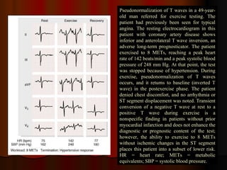 Pseudonormalization of T waves in a 49-year-old man referred for exercise testing. The patient had previously been seen for typical angina. The resting electrocardiogram in this patient with coronary artery disease shows inferior and anterolateral T wave inversion, an adverse long-term prognosticator. The patient exercised to 8 METs, reaching a peak heart rate of 142 beats/min and a peak systolic blood pressure of 248 mm Hg. At that point, the test was stopped because of hypertension. During exercise, pseudonormalization of T waves occurs, and it returns to baseline (inverted T wave) in the postexercise phase. The patient denied chest discomfort, and no arrhythmia or ST segment displacement was noted. Transient conversion of a negative T wave at rest to a positive T wave during exercise is a nonspecific finding in patients without prior myocardial infarction and does not enhance the diagnostic or prognostic content of the test; however, the ability to exercise to 8 METs without ischemic changes in the ST segment places this patient into a subset of lower risk. HR = heart rate; METs = metabolic equivalents; SBP = systolic blood pressure.  