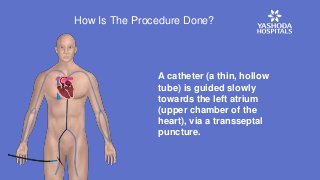 A catheter (a thin, hollow
tube) is guided slowly
towards the left atrium
(upper chamber of the
heart), via a transseptal
puncture.
How Is The Procedure Done?
 