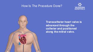 Transcatheter heart valve is
advanced through the
catheter and positioned
along the mitral valve.
How Is The Procedure Done?
 