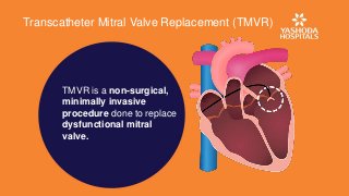 Transcatheter Mitral Valve Replacement (TMVR)
TMVR is a non-surgical,
minimally invasive
procedure done to replace
dysfunctional mitral
valve.
 