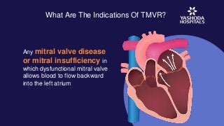 What Are The Indications Of TMVR?
Any mitral valve disease
or mitral insufficiency in
which dysfunctional mitral valve
allows blood to flow backward
into the left atrium
 