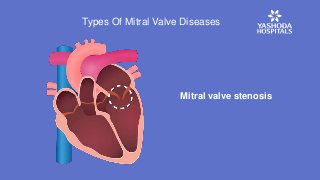 Mitral valve stenosis
Types Of Mitral Valve Diseases
 