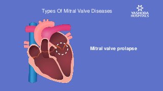 Mitral valve prolapse
Types Of Mitral Valve Diseases
 