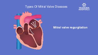 Mitral valve regurgitation
Types Of Mitral Valve Diseases
 