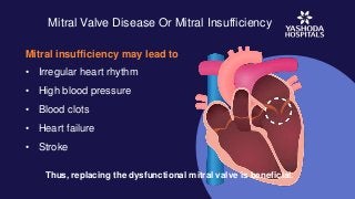 Mitral Valve Disease Or Mitral Insufficiency
Mitral insufficiency may lead to
• Irregular heart rhythm
• High blood pressure
• Blood clots
• Heart failure
• Stroke
Thus, replacing the dysfunctional mitral valve is beneficial.
 