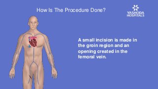 How Is The Procedure Done?
A small incision is made in
the groin region and an
opening created in the
femoral vein.
 