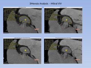 TMVR Valve in valve implantation with Myval 1.pptx