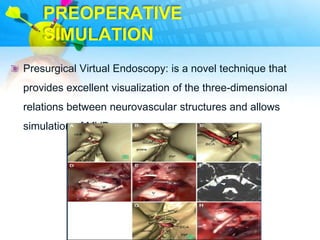 PREOPERATIVE
    SIMULATION
Presurgical Virtual Endoscopy: is a novel technique that
provides excellent visualization of the three-dimensional
relations between neurovascular structures and allows
simulation of MVD
 