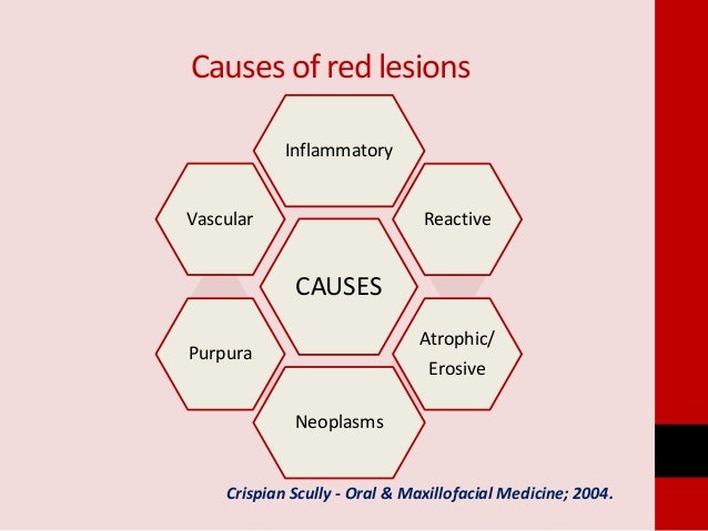 Red And White Lesions Of Oral Cavity