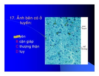 17. AÛnh beân coù ôû17. AÛnh beân coù ôû
tuyeán:tuyeán:
A yeânA yeân
B caän giaùp
C thöôïng thaän
D tuïy
 