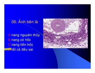 05. AÛnh beân laø05. AÛnh beân laø
A nang nguyeân thuûyA nang nguyeân thuûy
B nang coù hoác
C nang tieàn hoác
D taát caû ñeàu sai
 