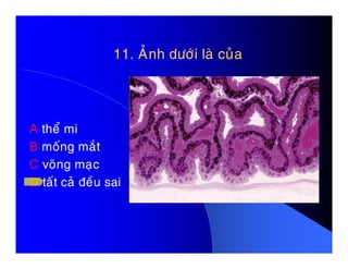 11. AÛnh döôùi laø cuûa11. AÛnh döôùi laø cuûa
A theå miA theå mi
B moáng maét
C voõng maïc
D taát caû ñeàu sai
 