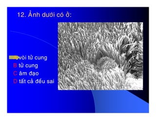 12. AÛnh döôùi coù ôû:12. AÛnh döôùi coù ôû:
A voøi töû cungA voøi töû cung
B töû cung
C aâm ñaïo
D taát caû ñeàu sai
 