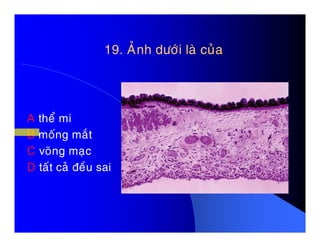 19. AÛnh döôùi laø cuûa19. AÛnh döôùi laø cuûa
A theå miA theå mi
B moáng maét
C voõng maïc
D taát caû ñeàu sai
 