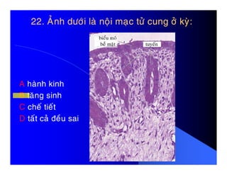 22. AÛnh döôùi laø noäi maïc töû cung ôû kyø:22. AÛnh döôùi laø noäi maïc töû cung ôû kyø:
A haønh kinhA haønh kinh
B taêng sinh
C cheá tieát
D taát caû ñeàu sai
 
