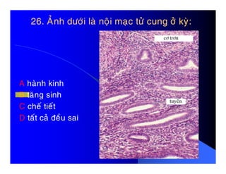 26. AÛnh döôùi laø noäi maïc töû cung ôû kyø:26. AÛnh döôùi laø noäi maïc töû cung ôû kyø:
A haønh kinhA haønh kinh
B taêng sinh
C cheá tieát
D taát caû ñeàu sai
 