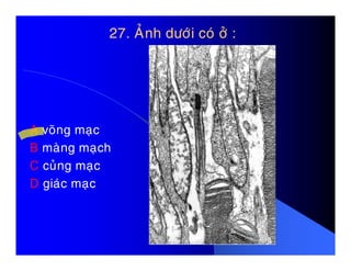 27. AÛnh döôùi coù ôû :27. AÛnh döôùi coù ôû :
A voõng maïcA voõng maïc
B maøng maïch
C cuûng maïc
D giaùc maïc
 