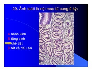 29. AÛnh döôùi laø noäi maïc töû cung ôû kyø:29. AÛnh döôùi laø noäi maïc töû cung ôû kyø:
A haønh kinhA haønh kinh
B taêng sinh
C cheá tieát
D taát caû ñeàu sai
 