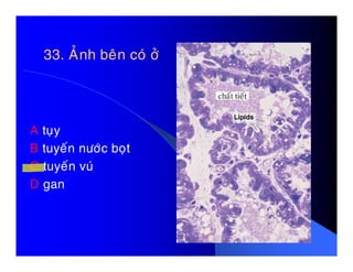 33. AÛnh beân coù ôû33. AÛnh beân coù ôû
A tuïyA tuïy
B tuyeán nöôùc boït
C tuyeán vuù
D gan
 