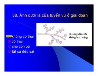 38. AÛnh döôùi laø cuûa tuyeán vuù ôû giai ñoaïn38. AÛnh döôùi laø cuûa tuyeán vuù ôû giai ñoaïn
A khoâng coù thaiA khoâng coù thai
B coù thai
C cho con buù
D taát caû ñeàu sai
 