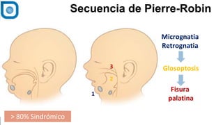 1
Secuencia de Pierre-Robin
1
3
2
Micrognatia
Retrognatia
Glosoptosis
Fisura
palatina
> 80% Sindrómico
 