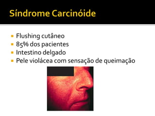    Flushing cutâneo
   85% dos pacientes
   Intestino delgado
   Pele violácea com sensação de queimação
 