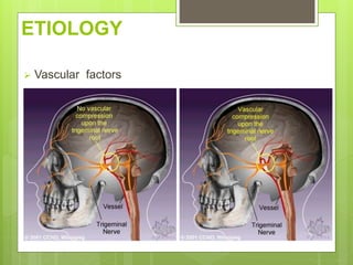 ETIOLOGY
 Vascular factors
 