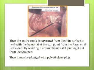 Then the entire trunk is separated from the skin surface is
held with the hemostat at the exit point from the foramen &
is removed by winding it around hemostat & pulling it out
from the foramen.
Then it may be plugged with polyethylene plug.
 