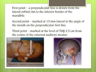 First point – a perpendicular line is drawn from the
lateral orbital rim to the inferior border of the
mandible.
Second point – marked at 15 mm lateral to the angle of
the mouth on the perpendicular first line
Third point – marked at the level of TMJ 2.5 cm from
the centre of the external auditory meatus.
 