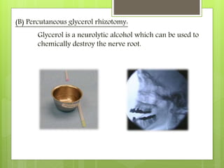 (B) Percutaneous glycerol rhizotomy:
Glycerol is a neurolytic alcohol which can be used to
chemically destroy the nerve root.
 