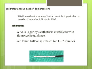 (C) Percutaneous balloon compression:
This is a mechanical means of destruction of the trigeminal nerve
introduced by Mullan & Lichtor in 1980.
Technique:
A no. 4 Fogarthy’s catheter is introduced with
fluoroscopic guidance.
A 0.7 mm balloon is inflated for 1 – 2 minutes.
 