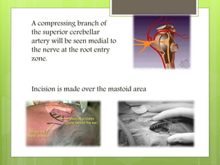 A compressing branch of
the superior cerebellar
artery will be seen medial to
the nerve at the root entry
zone.
Incision is made over the mastoid area
 