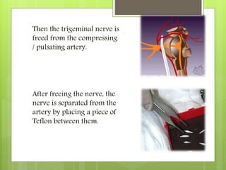 Then the trigeminal nerve is
freed from the compressing
/ pulsating artery.
After freeing the nerve, the
nerve is separated from the
artery by placing a piece of
Teflon between them.
 