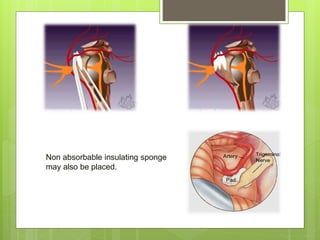 Non absorbable insulating sponge
may also be placed.
 