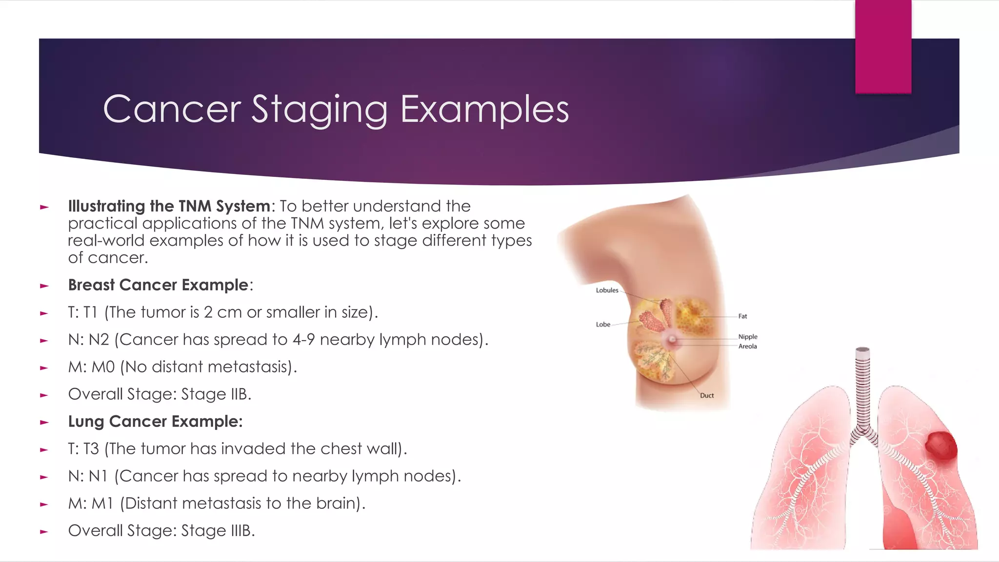 TNM Classification and Implication to Cancer Staging.pdf