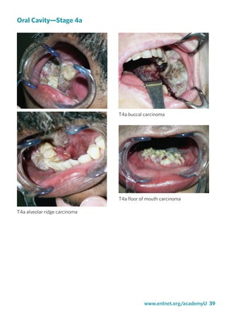 www.entnet.org/academyU 39
Oral Cavity—Stage 4a
T4a alveolar ridge carcinoma
T4a buccal carcinoma
T4a floor of mouth carci...
