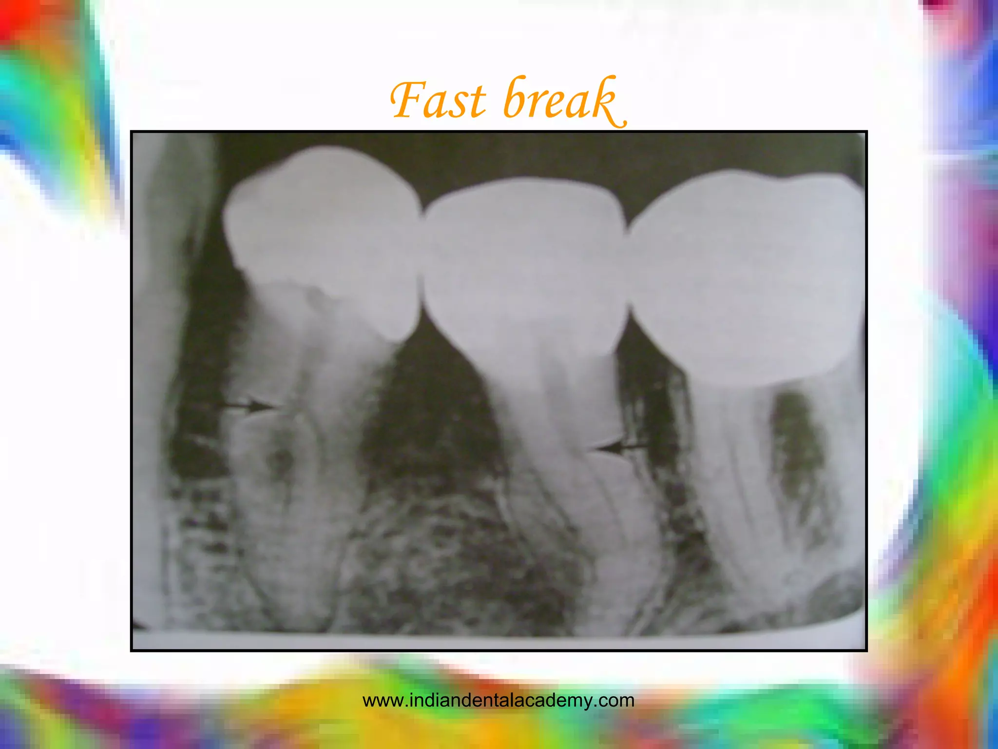 Fast break
www.indiandentalacademy.com
 
