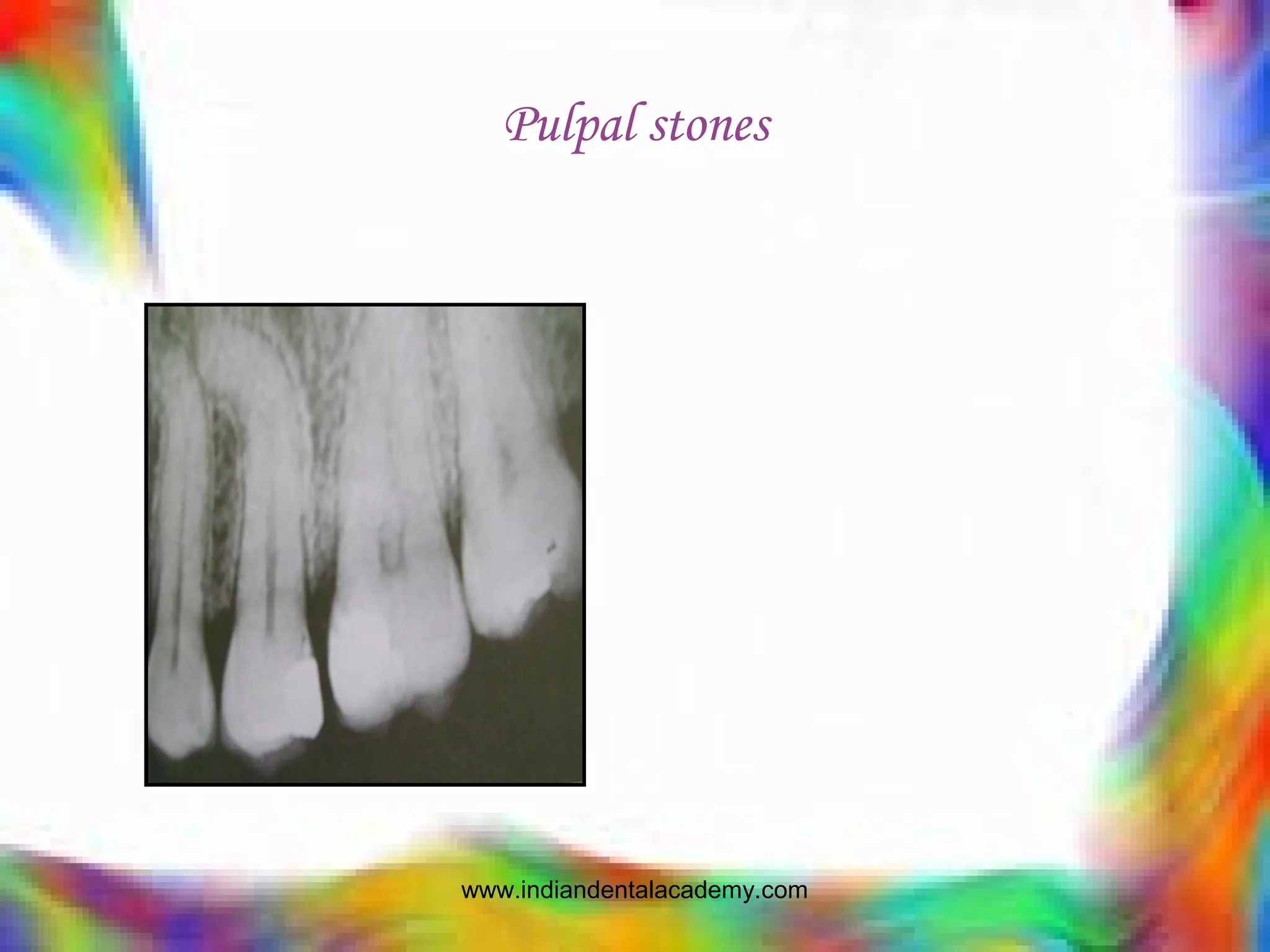 Pulpal stones
www.indiandentalacademy.com
 