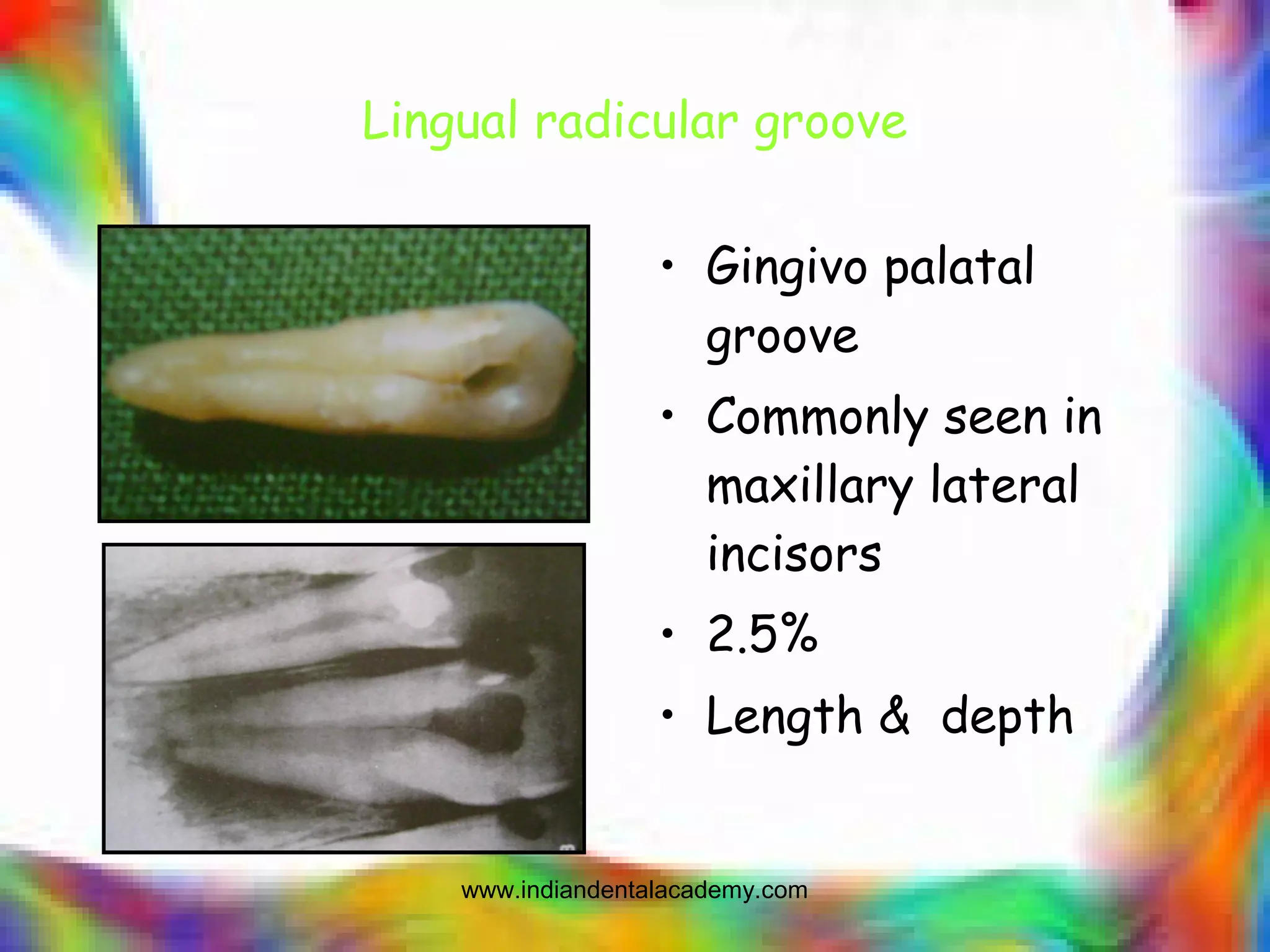 Lingual radicular groove
• Gingivo palatal
groove
• Commonly seen in
maxillary lateral
incisors
• 2.5%
• Length & depth
www.indiandentalacademy.com
 